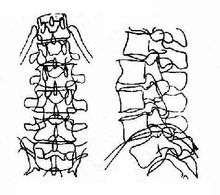 正常(左)与患病的(右)腰椎对比图